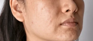 Pigmentation Treatment in Chembur at Luminous Skin and Hair Clinic