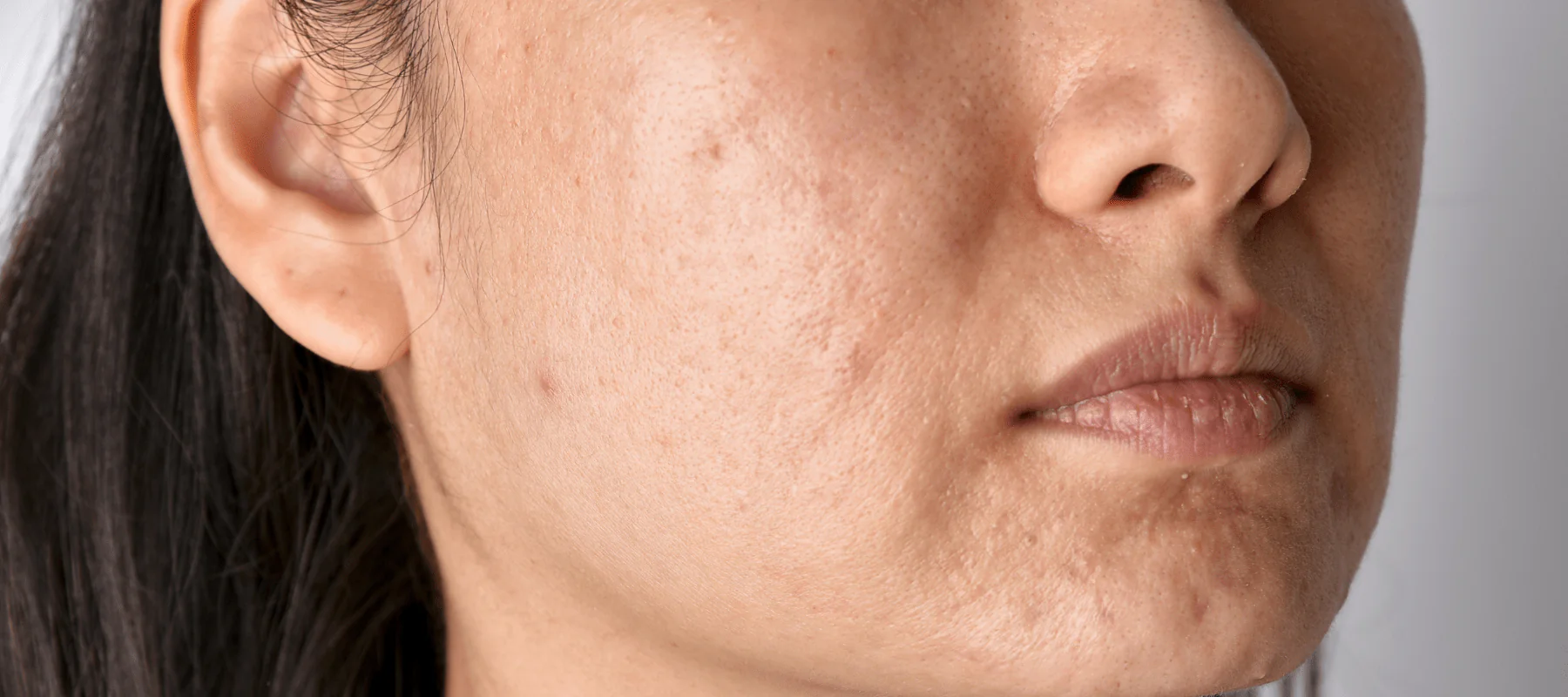Pigmentation Treatment in Chembur at Luminous Skin and Hair Clinic